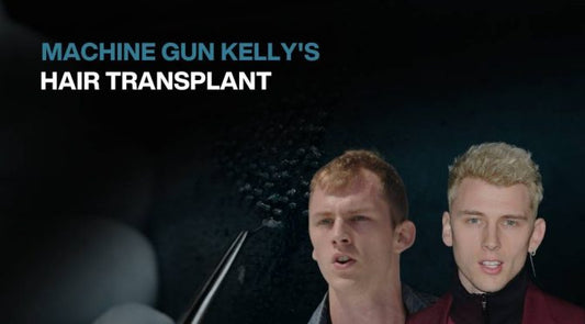 Did Machine Gun Kelly Get A Hair Transplant? Inner G Complete Wellness